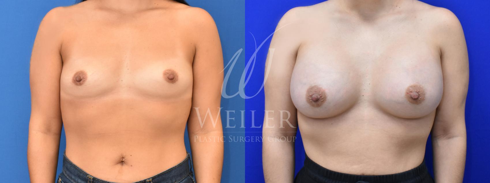 Before & After Breast Augmentation Case 821 Front View in Baton Rouge, New Orleans, & Lafayette, Louisiana