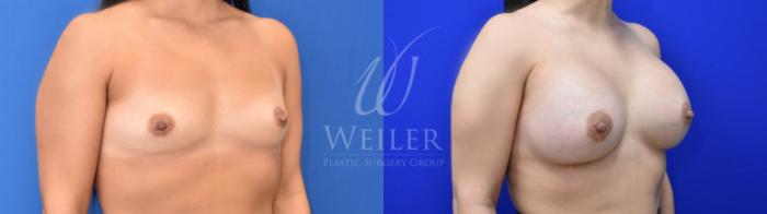 Before & After Breast Augmentation Case 821 Right Oblique View in Baton Rouge, New Orleans, & Lafayette, Louisiana