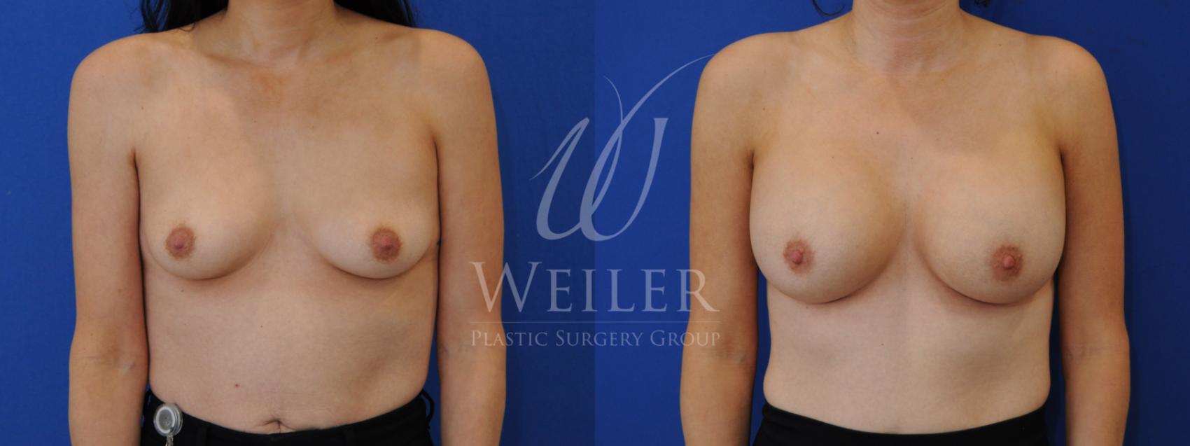 Before & After Breast Augmentation Case 823 Front View in Baton Rouge, New Orleans, & Lafayette, Louisiana