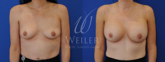 Before & After Breast Augmentation Case 823 Front View in Baton Rouge, New Orleans, & Lafayette, Louisiana