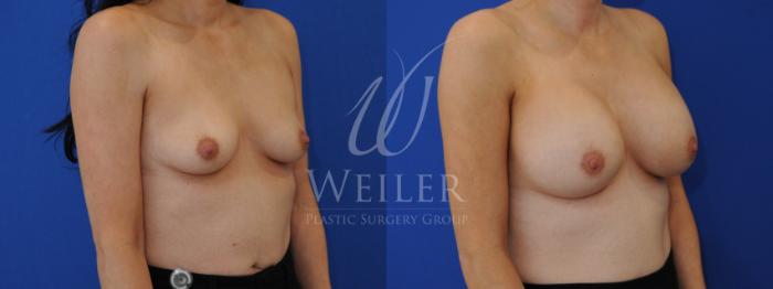 Before & After Breast Augmentation Case 823 Right Oblique View in Baton Rouge, New Orleans, & Lafayette, Louisiana