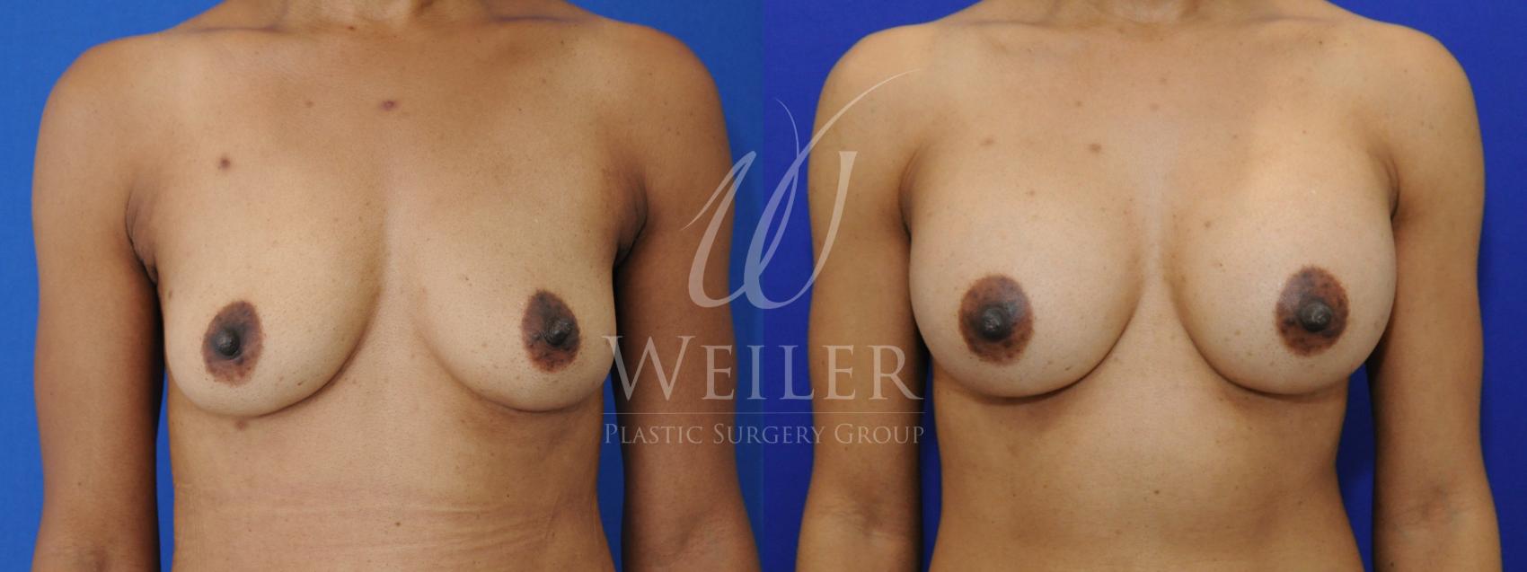 Before & After Breast Augmentation Case 844 Front View in Baton Rouge, Louisiana