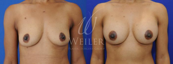 Before & After Breast Augmentation Case 844 Front View in Baton Rouge, New Orleans, & Lafayette, Louisiana