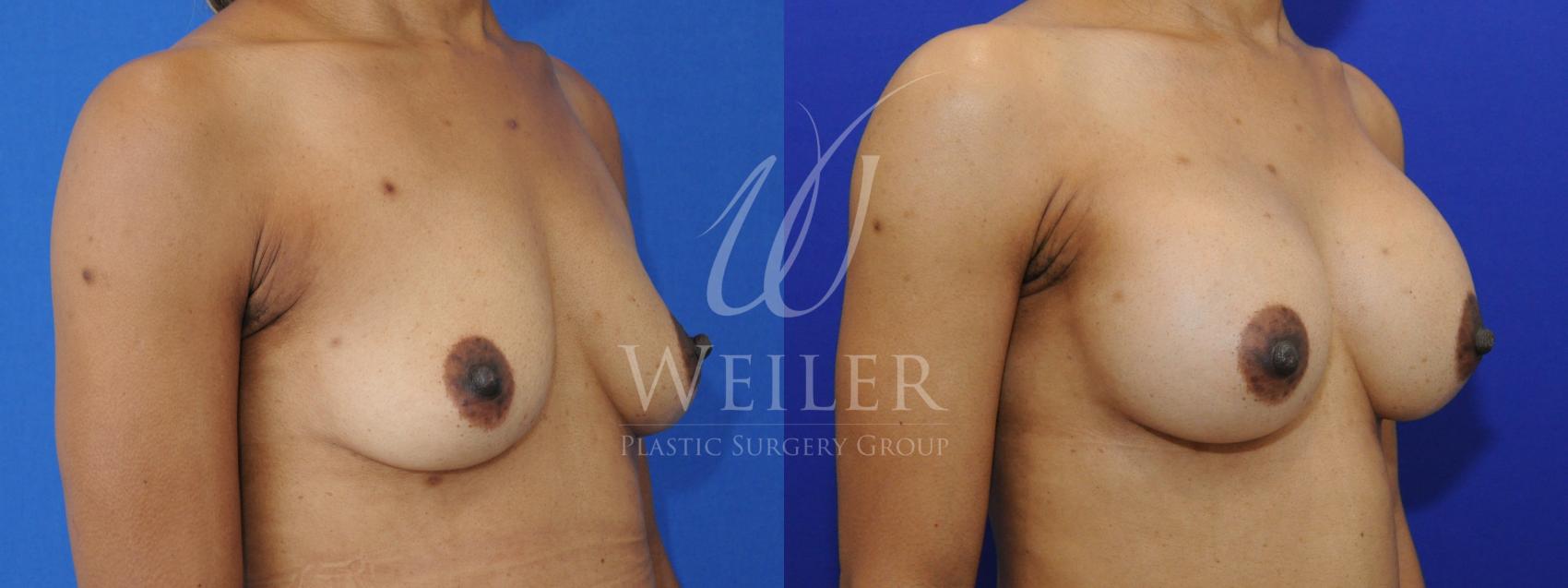 Before & After Breast Augmentation Case 844 Right Oblique View in Baton Rouge, Louisiana
