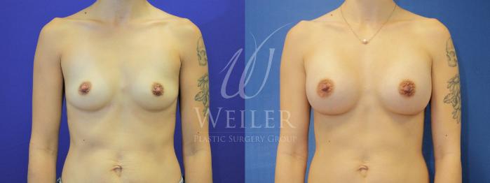 Before & After Breast Augmentation Case 845 Front View in Baton Rouge, Louisiana