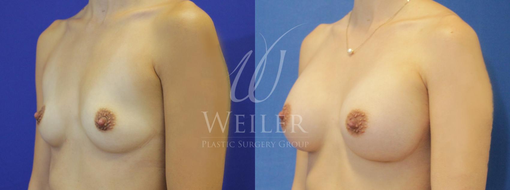 Before & After Breast Augmentation Case 845 Left Oblique View in Baton Rouge, Louisiana
