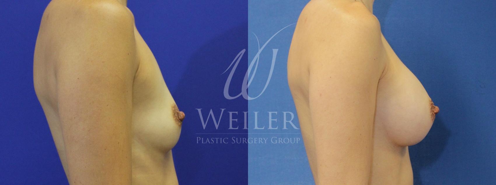 Before & After Breast Augmentation Case 845 Right Side View in Baton Rouge, Louisiana
