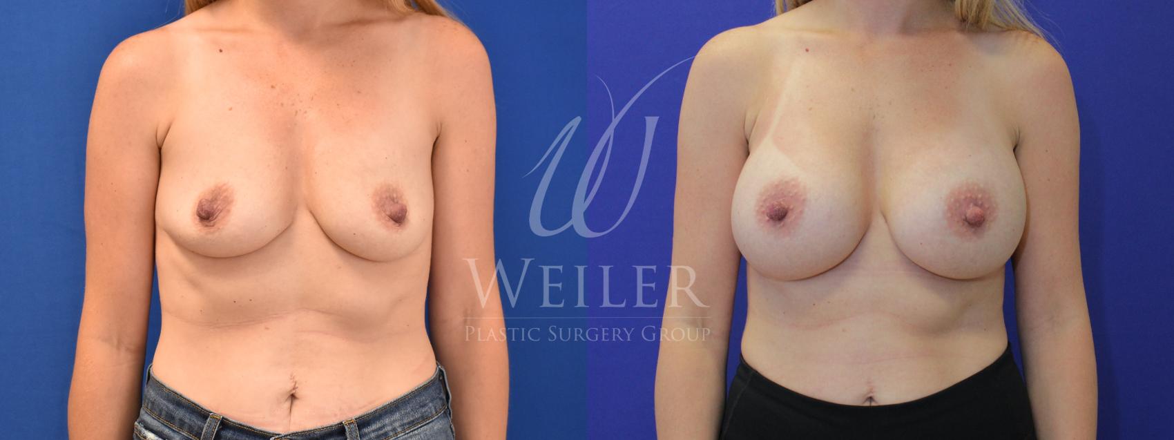 Before & After Breast Augmentation Case 850 Front View in Baton Rouge, New Orleans, & Lafayette, Louisiana