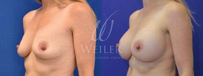 Before & After Breast Augmentation Case 850 Left Oblique View in Baton Rouge, New Orleans, & Lafayette, Louisiana