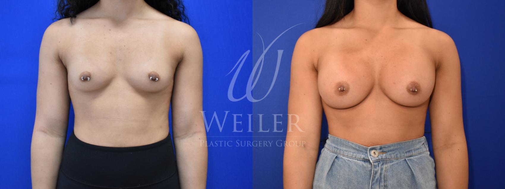 Before & After Breast Augmentation Case 858 Front View in Baton Rouge, Louisiana