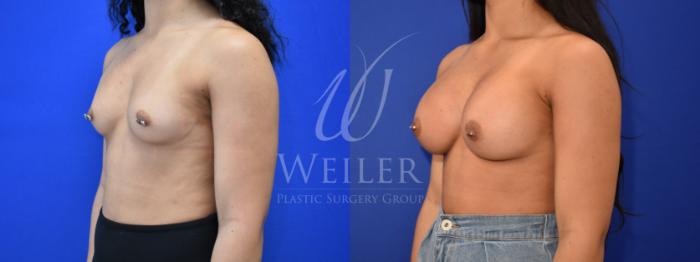 Before & After Breast Augmentation Case 858 Left Oblique View in Baton Rouge, New Orleans, & Lafayette, Louisiana
