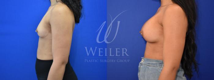 Before & After Breast Augmentation Case 858 Left Side View in Baton Rouge, New Orleans, & Lafayette, Louisiana