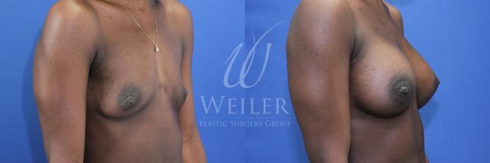 Before & After Breast Augmentation Case 868 Right Oblique View in Baton Rouge, Louisiana