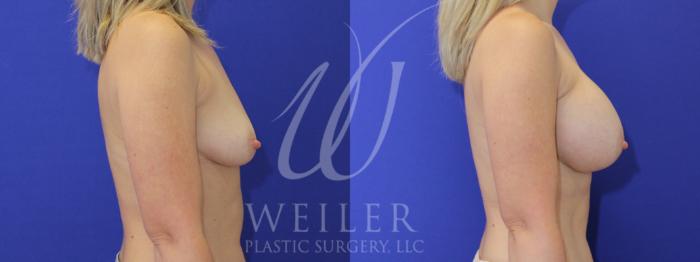 Before & After Breast Augmentation Case 891 Right Side View in Baton Rouge, New Orleans, & Lafayette, Louisiana