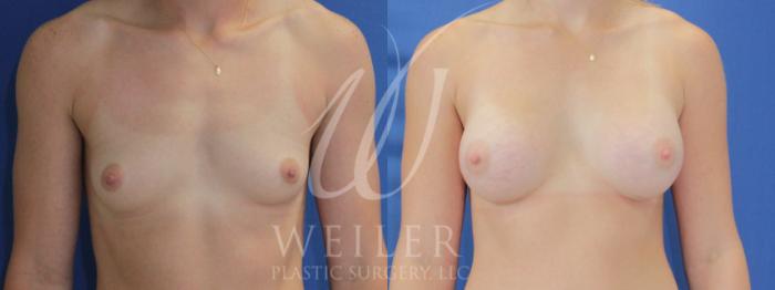 Before & After Breast Augmentation Case 893 Front View in Baton Rouge, Louisiana