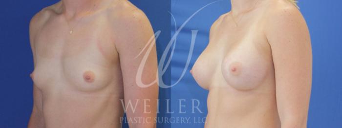 Before & After Breast Augmentation Case 893 Left Oblique View in Baton Rouge, Louisiana