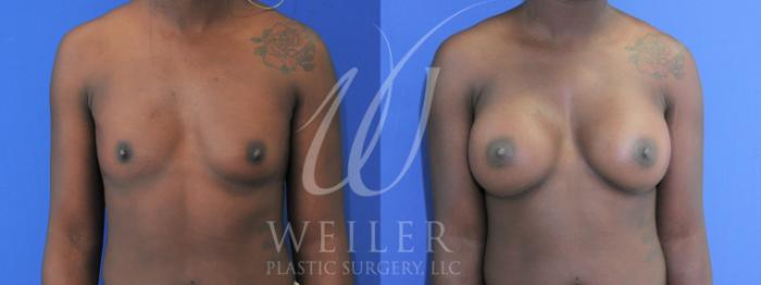 Before & After Breast Augmentation Case 894 Front View in Baton Rouge, New Orleans, & Lafayette, Louisiana