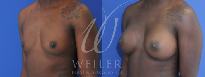 Before & After Breast Augmentation Case 894 Left Oblique View in Baton Rouge, New Orleans, & Lafayette, Louisiana