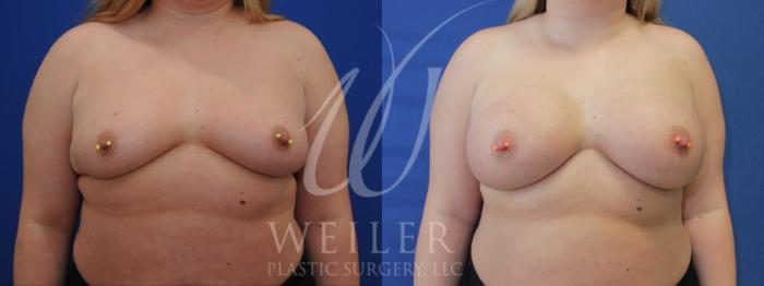 Before & After Breast Augmentation Case 901 Front View in Baton Rouge, New Orleans, & Lafayette, Louisiana