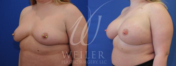 Before & After Breast Augmentation Case 901 Left Oblique View in Baton Rouge, New Orleans, & Lafayette, Louisiana