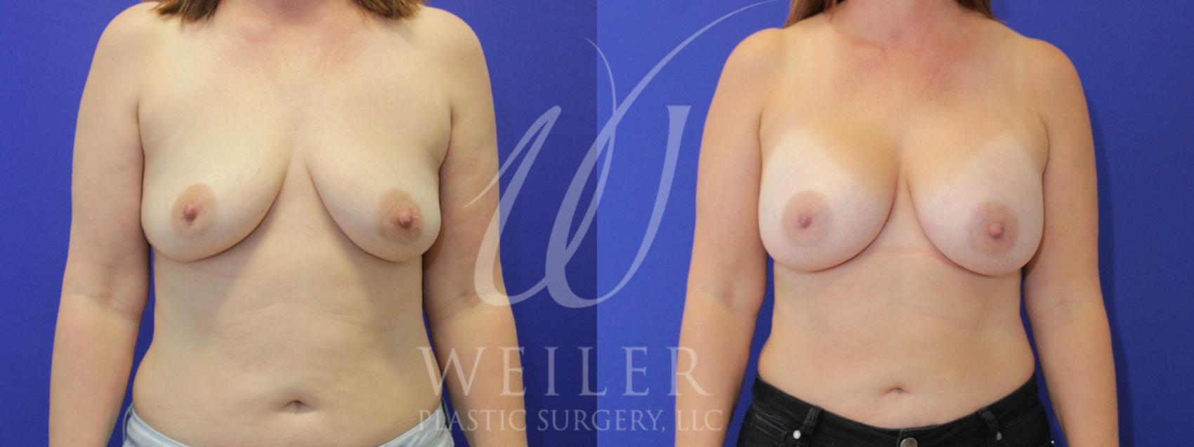 Before & After Breast Augmentation Case 902 Front View in Baton Rouge, New Orleans, & Lafayette, Louisiana