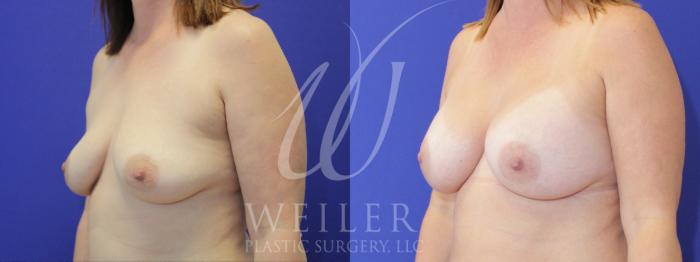 Before & After Breast Augmentation Case 902 Left Oblique View in Baton Rouge, New Orleans, & Lafayette, Louisiana