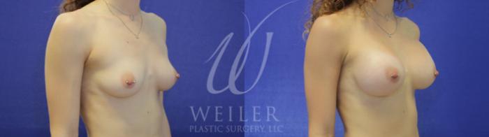 Before & After Breast Augmentation Case 903 Right Oblique View in Baton Rouge, New Orleans, & Lafayette, Louisiana