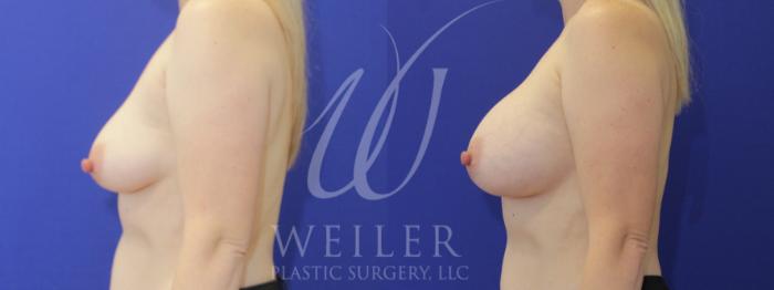 Before & After Breast Augmentation Case 906 Left Side View in Baton Rouge, New Orleans, & Lafayette, Louisiana
