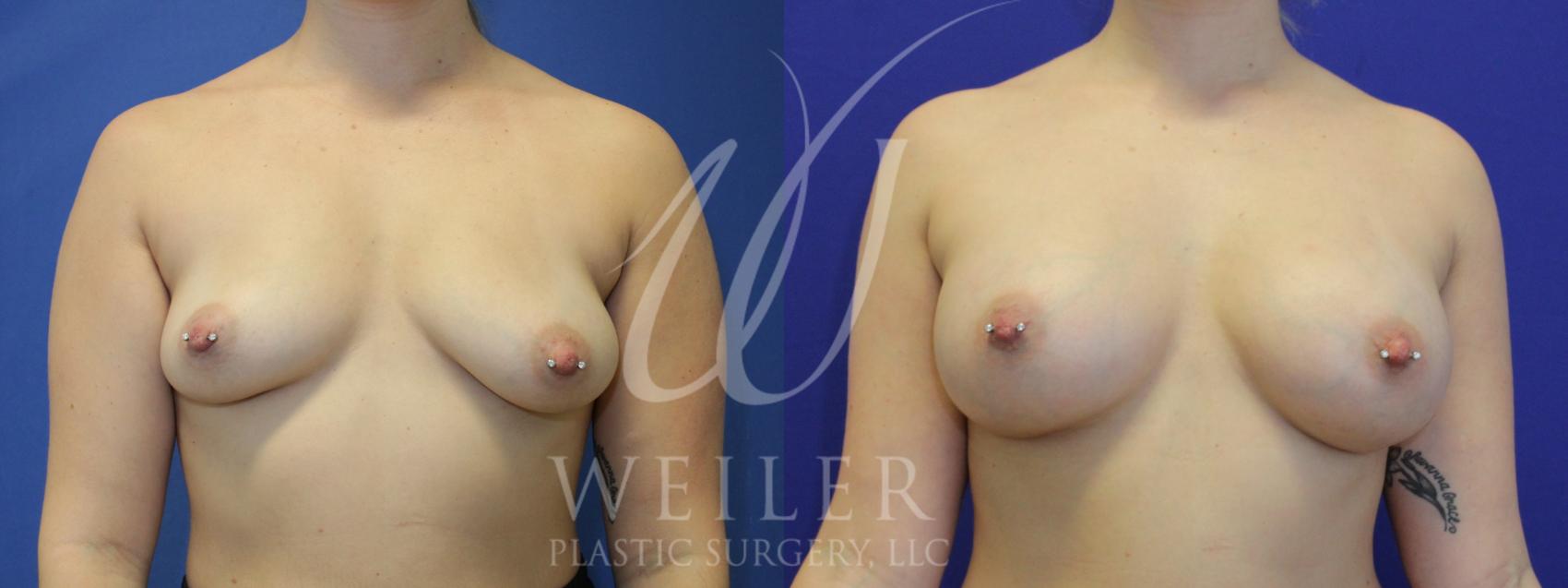 Before & After Breast Augmentation Case 914 Front View in Baton Rouge, New Orleans, & Lafayette, Louisiana