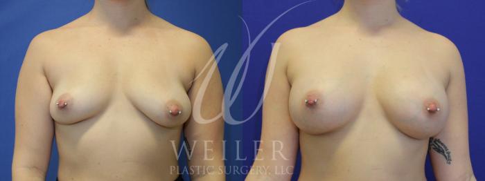 Before & After Breast Augmentation Case 914 Front View in Baton Rouge, New Orleans, & Lafayette, Louisiana