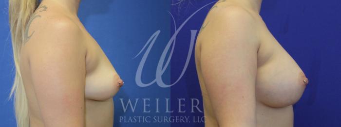 Before & After Breast Augmentation Case 914 Right Side View in Baton Rouge, New Orleans, & Lafayette, Louisiana