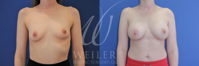 Before & After Breast Augmentation Case 922 Front View in Baton Rouge, New Orleans, & Lafayette, Louisiana