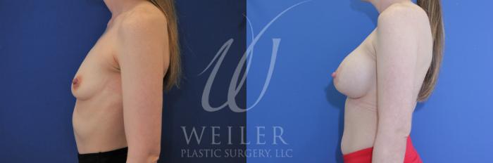 Before & After Breast Augmentation Case 922 Left Side View in Baton Rouge, New Orleans, & Lafayette, Louisiana