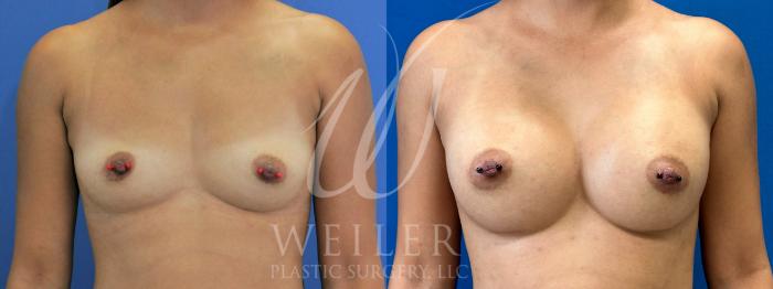 Before & After Breast Augmentation Case 924 Front View in Baton Rouge, Louisiana