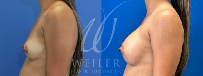 Before & After Breast Augmentation Case 924 Left Side View in Baton Rouge, Louisiana