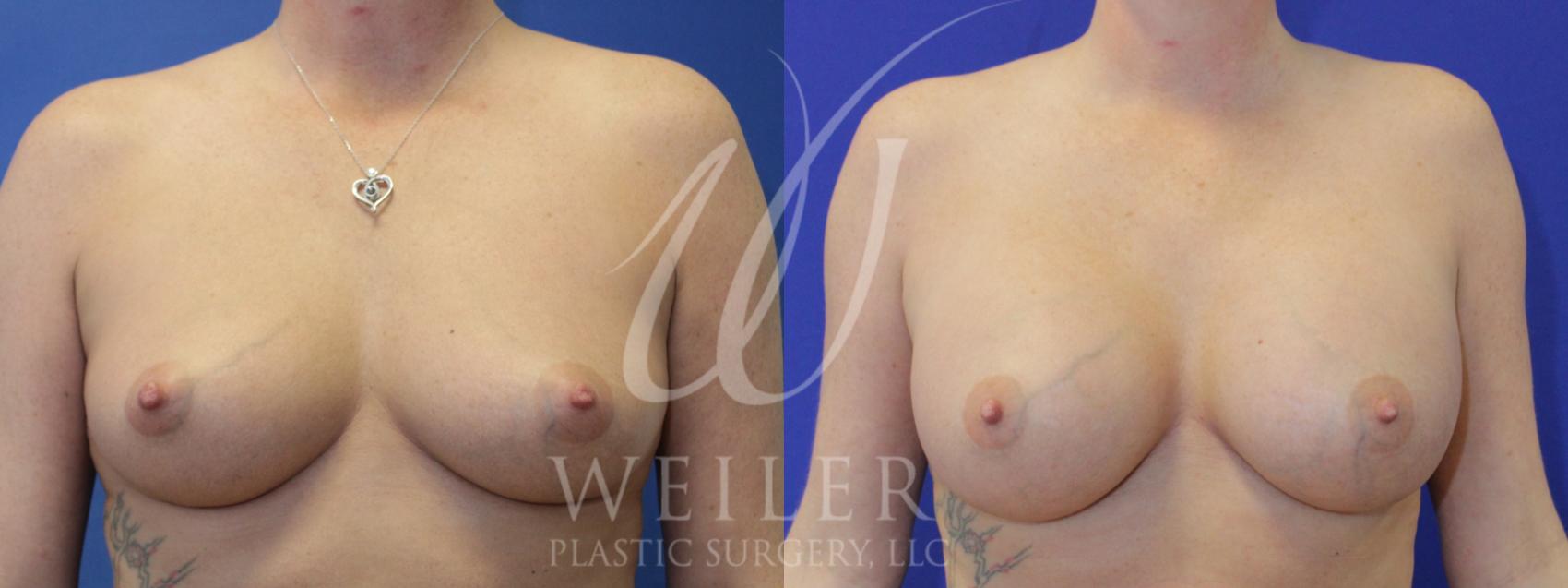 Before & After Breast Augmentation Case 932 Front View in Baton Rouge, Louisiana