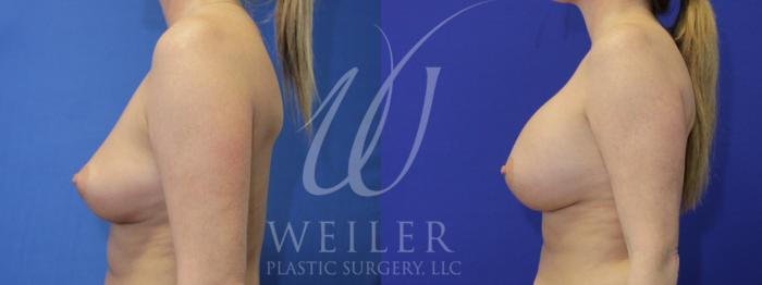 Before & After Breast Augmentation Case 932 Left Side View in Baton Rouge, Louisiana
