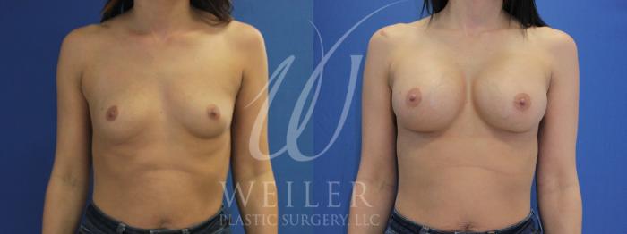 Before & After Breast Augmentation Case 972 Front View in Baton Rouge, New Orleans, & Lafayette, Louisiana