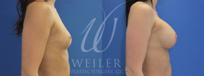Before & After Breast Augmentation Case 972 Right Side View in Baton Rouge, New Orleans, & Lafayette, Louisiana