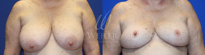Before & After Breast Cancer Reconstruction Case 1137 Front View in Baton Rouge, New Orleans, & Lafayette, Louisiana