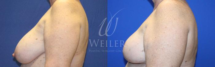 Before & After Breast Cancer Reconstruction Case 1137 Right Side View in Baton Rouge, New Orleans, & Lafayette, Louisiana