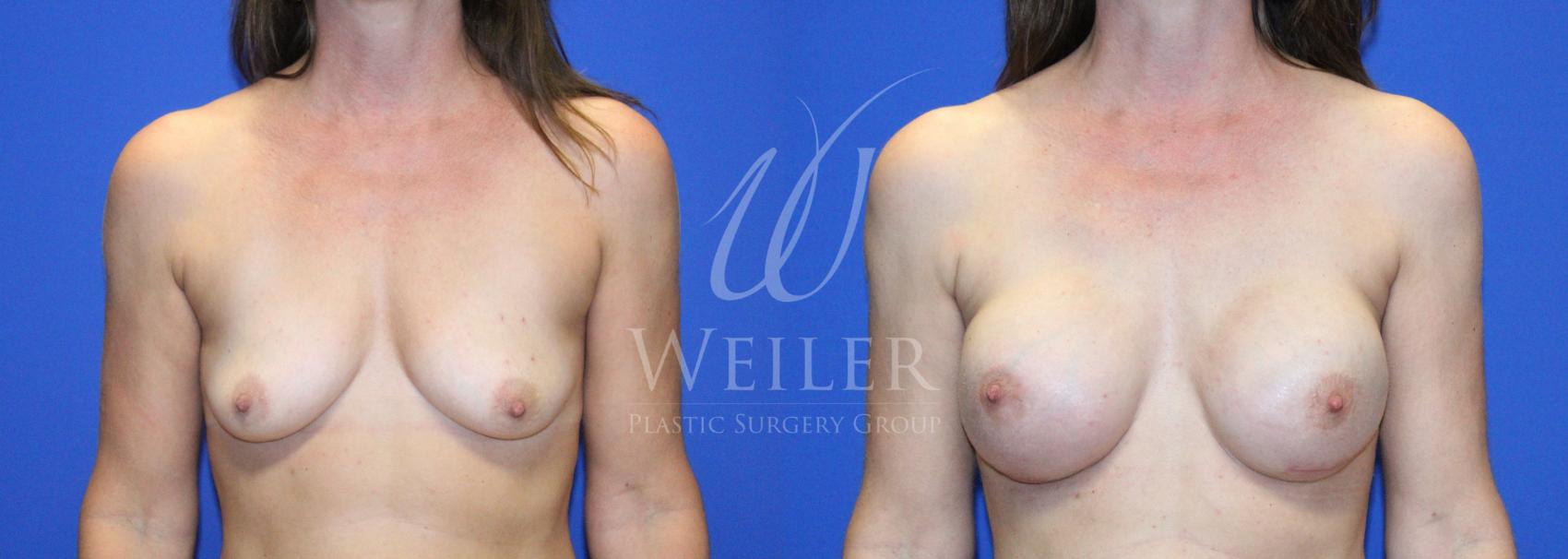 Before & After Breast Cancer Reconstruction Case 1139 Front View in Baton Rouge, New Orleans, & Lafayette, Louisiana