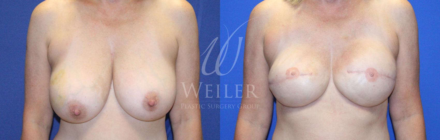 Before & After Breast Cancer Reconstruction Case 1140 Front View in Baton Rouge, New Orleans, & Lafayette, Louisiana