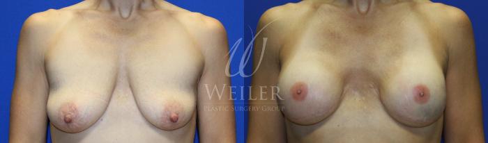 Before & After Breast Cancer Reconstruction Case 1144 Front View in Baton Rouge, New Orleans, & Lafayette, Louisiana