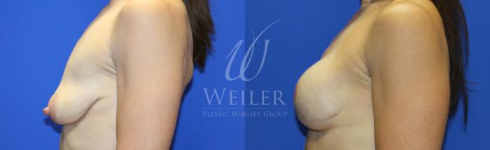 Before & After Breast Cancer Reconstruction Case 1144 Right Side View in Baton Rouge, New Orleans, & Lafayette, Louisiana