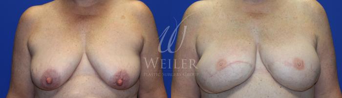 Before & After Breast Cancer Reconstruction Case 1145 Front View in Baton Rouge, New Orleans, & Lafayette, Louisiana