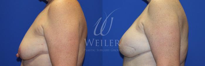 Before & After Breast Cancer Reconstruction Case 1145 Right Side View in Baton Rouge, New Orleans, & Lafayette, Louisiana
