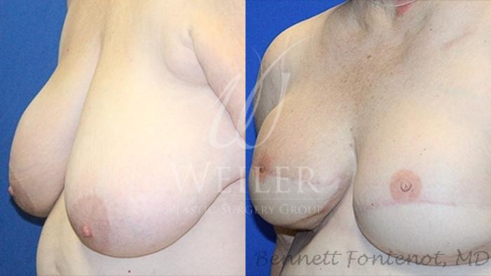 Before & After Breast Cancer Reconstruction Case 1219 Left Oblique View in Baton Rouge, New Orleans, & Lafayette, Louisiana