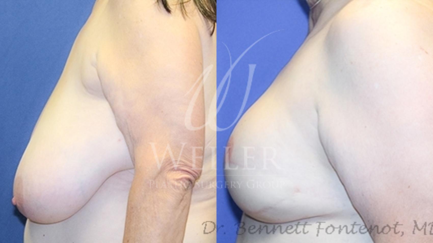 Before & After Breast Cancer Reconstruction Case 1219 Left Side View in Baton Rouge, New Orleans, & Lafayette, Louisiana