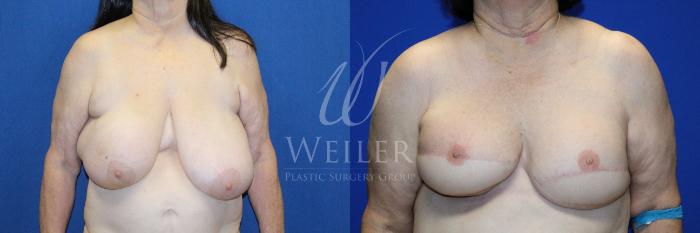 Before & After Breast Cancer Reconstruction Case 1231 Front View in Baton Rouge, New Orleans, & Lafayette, Louisiana